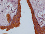 IHC image of CAC12109 diluted at 1:100 and staining in paraffin-embedded human prostate cancer performed on a Leica BondTM system. After dewaxing and hydration, antigen retrieval was mediated by high pressure in a citrate buffer (pH 6.0). Section was blocked with 10% normal goat serum 30min at RT. Then primary antibody (1% BSA) was incubated at 4°C overnight. The primary is detected by a Goat anti-rabbit polymer IgG labeled by HRP and visualized using 0.05% DAB.