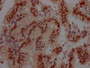 IHC image of CAC12113 diluted at 1:100 and staining in paraffin-embedded human prostate cancer performed on a Leica BondTM system. After dewaxing and hydration, antigen retrieval was mediated by high pressure in a citrate buffer (pH 6.0). Section was blocked with 10% normal goat serum 30min at RT. Then primary antibody (1% BSA) was incubated at 4? overnight. The primary is detected by a Goat anti-rabbit IgG polymer labeled by HRP and visualized using 0.05% DAB.