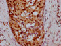 IHC image of CAC12116 diluted at 1:100 and staining in paraffin-embedded human breast cancer performed on a Leica BondTM system. After dewaxing and hydration, antigen retrieval was mediated by high pressure in a citrate buffer (pH 6.0). Section was blocked with 10% normal goat serum 30min at RT. Then primary antibody (1% BSA) was incubated at 4? overnight. The primary is detected by a Goat anti-rabbit IgG polymer labeled by HRP and visualized using 0.05% DAB.