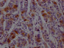 IHC image of CAC12133 diluted at 1:100 and staining in paraffin-embedded human breast cancer performed on a Leica BondTM system. After dewaxing and hydration, antigen retrieval was mediated by high pressure in a citrate buffer (pH 6.0). Section was blocked with 10% normal goat serum 30min at RT. Then primary antibody (1% BSA) was incubated at 4? overnight. The primary is detected by a Goat anti-rabbit IgG polymer labeled by HRP and visualized using 0.05% DAB.