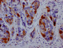 IHC image of CAC12133 diluted at 1:100 and staining in paraffin-embedded human liver cancer performed on a Leica BondTM system. After dewaxing and hydration, antigen retrieval was mediated by high pressure in a citrate buffer (pH 6.0). Section was blocked with 10% normal goat serum 30min at RT. Then primary antibody (1% BSA) was incubated at 4? overnight. The primary is detected by a Goat anti-rabbit IgG polymer labeled by HRP and visualized using 0.05% DAB.