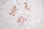 IHC image of CAC12141 diluted at 1:50 and staining in paraffin-embedded human breast cancer performed on a Leica BondTM system. After dewaxing and hydration, antigen retrieval was mediated by high pressure in a citrate buffer (pH 6.0). Section was blocked with 10% normal goat serum 30min at RT. Then primary antibody (1% BSA) was incubated at 4°C overnight. The primary is detected by a Goat anti-rabbit polymer IgG labeled by HRP and visualized using 0.58% DAB.
