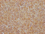IHC image of CAC12149 diluted at 1:100 and staining in paraffin-embedded human glioma cancer performed on a Leica BondTM system. After dewaxing and hydration, antigen retrieval was mediated by high pressure in a citrate buffer (pH 6.0). Section was blocked with 10% normal goat serum 30min at RT. Then primary antibody (1% BSA) was incubated at 4? overnight. The primary is detected by a Goat anti-rabbit IgG polymer labeled by HRP and visualized using 0.05% DAB.