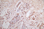 IHC image diluted at 1:600 and staining in paraffin-embedded human breast cancer performed on a Leica BondTM system. After dewaxing and hydration, antigen retrieval was mediated by high pressure in a citrate buffer (pH 6.0). Section was blocked with 10% normal goat serum 30min at RT. Then primary antibody (1% BSA) was incubated at 4°C overnight. The primary is detected by a Goat anti-Mouse IgG labeled by HRP and visualized using 0.05% DAB.