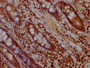 IHC image of CAC12162 diluted at 1:100 and staining in paraffin-embedded human colon cancer performed on a Leica BondTM system. After dewaxing and hydration, antigen retrieval was mediated by high pressure in a citrate buffer (pH 6.0). Section was blocked with 10% normal goat serum 30min at RT. Then primary antibody (1% BSA) was incubated at 4? overnight. The primary is detected by a Goat anti-rabbit IgG polymer labeled by HRP and visualized using 0.05% DAB.