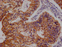 IHC image of CAC12169 diluted at 1:100 and staining in paraffin-embedded human endometrial cancer performed on a Leica BondTM system. After dewaxing and hydration, antigen retrieval was mediated by high pressure in a citrate buffer (pH 6.0). Section was blocked with 10% normal goat serum 30min at RT. Then primary antibody (1% BSA) was incubated at 4°C overnight. The primary is detected by a Goat anti-rabbit polymer IgG labeled by HRP and visualized using 0.05% DAB.