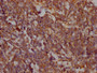 IHC image of CAC12170 diluted at 1:100 and staining in paraffin-embedded human lung cancer performed on a Leica BondTM system. After dewaxing and hydration, antigen retrieval was mediated by high pressure in a citrate buffer (pH 6.0). Section was blocked with 10% normal goat serum 30min at RT. Then primary antibody (1% BSA) was incubated at 4? overnight. The primary is detected by a Goat anti-rabbit IgG polymer labeled by HRP and visualized using 0.05% DAB.