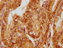 IHC image of CAC12189 diluted at 1:180 and staining in paraffin-embedded human endometrial cancer performed on a Leica BondTM system. After dewaxing and hydration, antigen retrieval was mediated by high pressure in a citrate buffer (pH 6.0). Section was blocked with 10% normal goat serum 30min at RT. Then primary antibody (1% BSA) was incubated at 4? overnight. The primary is detected by a biotinylated secondary antibody and visualized using an HRP conjugated SP system.