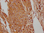 IHC image of CAC12206 diluted at 1:100 and staining in paraffin-embedded human cervical cancer performed on a Leica BondTM system. After dewaxing and hydration, antigen retrieval was mediated by high pressure in a citrate buffer (pH 6.0). Section was blocked with 10% normal goat serum 30min at RT. Then primary antibody (1% BSA) was incubated at 4? overnight. The primary is detected by a Goat anti-rabbit IgG polymer labeled by HRP and visualized using 0.05% DAB.