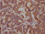 IHC image of CAC12221 diluted at 1:100 and staining in paraffin-embedded human breast cancer performed on a Leica BondTM system. After dewaxing and hydration, antigen retrieval was mediated by high pressure in a citrate buffer (pH 6.0). Section was blocked with 10% normal goat serum 30min at RT. Then primary antibody (1% BSA) was incubated at 4? overnight. The primary is detected by a Goat anti-rabbit IgG polymer labeled by HRP and visualized using 0.05% DAB.