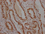 IHC image of CAC12230 diluted at 1:100 and staining in paraffin-embedded human prostate cancer performed on a Leica BondTM system. After dewaxing and hydration, antigen retrieval was mediated by high pressure in a citrate buffer (pH 6.0). Section was blocked with 10% normal goat serum 30min at RT. Then primary antibody (1% BSA) was incubated at 4? overnight. The primary is detected by a Goat anti-rabbit IgG polymer labeled by HRP and visualized using 0.05% DAB.