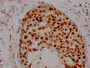 IHC image of CAC12232 diluted at 1:100 and staining in paraffin-embedded human breast cancer performed on a Leica BondTM system. After dewaxing and hydration, antigen retrieval was mediated by high pressure in a citrate buffer (pH 6.0). Section was blocked with 10% normal goat serum 30min at RT. Then primary antibody (1% BSA) was incubated at 4? overnight. The primary is detected by a Goat anti-rabbit IgG polymer labeled by HRP and visualized using 0.05% DAB.