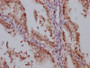 IHC image of CAC12233 diluted at 1:100 and staining in paraffin-embedded human endometrial cancer performed on a Leica BondTM system. After dewaxing and hydration, antigen retrieval was mediated by high pressure in a citrate buffer (pH 6.0). Section was blocked with 10% normal goat serum 30min at RT. Then primary antibody (1% BSA) was incubated at 4? overnight. The primary is detected by a Goat anti-rabbit IgG polymer labeled by HRP and visualized using 0.05% DAB.