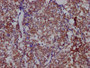 IHC image of CAC12233 diluted at 1:100 and staining in paraffin-embedded human lung cancer performed on a Leica BondTM system. After dewaxing and hydration, antigen retrieval was mediated by high pressure in a citrate buffer (pH 6.0). Section was blocked with 10% normal goat serum 30min at RT. Then primary antibody (1% BSA) was incubated at 4? overnight. The primary is detected by a Goat anti-rabbit IgG polymer labeled by HRP and visualized using 0.05% DAB.
