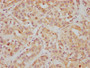 IHC image of CAC12234 diluted at 1:112.5 and staining in paraffin-embedded human liver cancer performed on a Leica BondTM system. After dewaxing and hydration, antigen retrieval was mediated by high pressure in a citrate buffer (pH 6.0). Section was blocked with 10% normal goat serum 30min at RT. Then primary antibody (1% BSA) was incubated at 4? overnight. The primary is detected by a biotinylated secondary antibody and visualized using an HRP conjugated SP system.