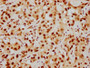 IHC image of CAC12235 diluted at 1:154 and staining in paraffin-embedded human liver cancer performed on a Leica BondTM system. After dewaxing and hydration, antigen retrieval was mediated by high pressure in a citrate buffer (pH 6.0). Section was blocked with 10% normal goat serum 30min at RT. Then primary antibody (1% BSA) was incubated at 4? overnight. The primary is detected by a biotinylated secondary antibody and visualized using an HRP conjugated SP system.