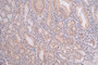 IHC image of CAC12241 diluted at 1:100 and staining in paraffin-embedded human gastric cancer performed on a Leica BondTM system. After dewaxing and hydration, antigen retrieval was mediated by high pressure in a citrate buffer (pH 6.0). Section was blocked with 10% normal goat serum 30min at RT. Then primary antibody (1% BSA) was incubated at 4°C overnight. The primary is detected by a Goat anti-rabbit polymer IgG labeled by HRP and visualized using 0.06% DAB.