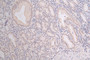 IHC image of CAC12242 diluted at 1:100 and staining in paraffin-embedded human gastric cancer performed on a Leica BondTM system. After dewaxing and hydration, antigen retrieval was mediated by high pressure in a citrate buffer (pH 6.0). Section was blocked with 10% normal goat serum 30min at RT. Then primary antibody (1% BSA) was incubated at 4°C overnight. The primary is detected by a Goat anti-rabbit polymer IgG labeled by HRP and visualized using 0.07% DAB.