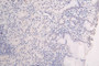 IHC image of CAC12243 diluted at 1:100 and staining in paraffin-embedded human gastric cancer performed on a Leica BondTM system. After dewaxing and hydration, antigen retrieval was mediated by high pressure in a citrate buffer (pH 6.0). Section was blocked with 10% normal goat serum 30min at RT. Then primary antibody (1% BSA) was incubated at 4°C overnight. The primary is detected by a Goat anti-rabbit polymer IgG labeled by HRP and visualized using 0.08% DAB.