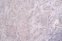 IHC image of CAC12244 diluted at 1:100 and staining in paraffin-embedded human gastric cancer performed on a Leica BondTM system. After dewaxing and hydration, antigen retrieval was mediated by high pressure in a citrate buffer (pH 6.0). Section was blocked with 10% normal goat serum 30min at RT. Then primary antibody (1% BSA) was incubated at 4°C overnight. The primary is detected by a Goat anti-rabbit polymer IgG labeled by HRP and visualized using 0.09% DAB.