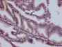 IHC image of CAC12248 diluted at 1:100 and staining in paraffin-embedded human prostate tissue performed on a Leica BondTM system. After dewaxing and hydration, antigen retrieval was mediated by high pressure in a citrate buffer (pH 6.0). Section was blocked with 10% normal goat serum 30min at RT. Then primary antibody (1% BSA) was incubated at 4°C overnight. The primary is detected by a Goat anti-rabbit polymer IgG labeled by HRP and visualized using 0.05% DAB.