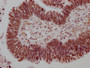 IHC image of CAC12256 diluted at 1:100 and staining in paraffin-embedded human ovarian cancer performed on a Leica BondTM system. After dewaxing and hydration, antigen retrieval was mediated by high pressure in a citrate buffer (pH 6.0). Section was blocked with 10% normal goat serum 30min at RT. Then primary antibody (1% BSA) was incubated at 4? overnight. The primary is detected by a Goat anti-rabbit IgG polymer labeled by HRP and visualized using 0.05% DAB.