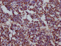 IHC image of CAC12258 diluted at 1:100 and staining in paraffin-embedded human liver cancer performed on a Leica BondTM system. After dewaxing and hydration, antigen retrieval was mediated by high pressure in a citrate buffer (pH 6.0). Section was blocked with 10% normal goat serum 30min at RT. Then primary antibody (1% BSA) was incubated at 4? overnight. The primary is detected by a Goat anti-rabbit IgG polymer labeled by HRP and visualized using 0.05% DAB.