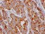IHC image of CAC12270 diluted at 1:100 and staining in paraffin-embedded human breast cancer performed on a Leica BondTM system. After dewaxing and hydration, antigen retrieval was mediated by high pressure in a citrate buffer (pH 6.0). Section was blocked with 10% normal goat serum 30min at RT. Then primary antibody (1% BSA) was incubated at 4? overnight. The primary is detected by a Goat anti-rabbit IgG polymer labeled by HRP and visualized using 0.05% DAB.