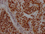 IHC image of CAC12279 diluted at 1:100 and staining in paraffin-embedded human cervical cancer performed on a Leica BondTM system. After dewaxing and hydration, antigen retrieval was mediated by high pressure in a citrate buffer (pH 6.0). Section was blocked with 10% normal goat serum 30min at RT. Then primary antibody (1% BSA) was incubated at 4? overnight. The primary is detected by a Goat anti-rabbit IgG polymer labeled by HRP and visualized using 0.05% DAB.