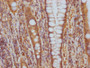 IHC image of CAC12287 diluted at 1:100 and staining in paraffin-embedded human colon cancer performed on a Leica BondTM system. After dewaxing and hydration, antigen retrieval was mediated by high pressure in a citrate buffer (pH 6.0). Section was blocked with 10% normal goat serum 30min at RT. Then primary antibody (1% BSA) was incubated at 4? overnight. The primary is detected by a Goat anti-rabbit IgG polymer labeled by HRP and visualized using 0.05% DAB.