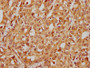 IHC image of CAC12297 diluted at 1:185 and staining in paraffin-embedded human liver cancer performed on a Leica BondTM system. After dewaxing and hydration, antigen retrieval was mediated by high pressure in a citrate buffer (pH 6.0). Section was blocked with 10% normal goat serum 30min at RT. Then primary antibody (1% BSA) was incubated at 4? overnight. The primary is detected by a biotinylated secondary antibody and visualized using an HRP conjugated SP system.