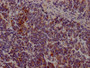 IHC image of CAC12301 diluted at 1:100 and staining in paraffin-embedded human lung cancer performed on a Leica BondTM system. After dewaxing and hydration, antigen retrieval was mediated by high pressure in a citrate buffer (pH 6.0). Section was blocked with 10% normal goat serum 30min at RT. Then primary antibody (1% BSA) was incubated at 4? overnight. The primary is detected by a Goat anti-rabbit IgG polymer labeled by HRP and visualized using 0.05% DAB.