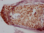 IHC image of CAC12302 diluted at 1:100 and staining in paraffin-embedded human breast cancer performed on a Leica BondTM system. After dewaxing and hydration, antigen retrieval was mediated by high pressure in a citrate buffer (pH 6.0). Section was blocked with 10% normal goat serum 30min at RT. Then primary antibody (1% BSA) was incubated at 4? overnight. The primary is detected by a Goat anti-rabbit IgG polymer labeled by HRP and visualized using 0.05% DAB.