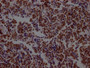 IHC image of CAC12304 diluted at 1:100 and staining in paraffin-embedded human lung cancer performed on a Leica BondTM system. After dewaxing and hydration, antigen retrieval was mediated by high pressure in a citrate buffer (pH 6.0). Section was blocked with 10% normal goat serum 30min at RT. Then primary antibody (1% BSA) was incubated at 4? overnight. The primary is detected by a Goat anti-rabbit IgG polymer labeled by HRP and visualized using 0.05% DAB.