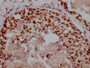 IHC image of CAC12315 diluted at 1:100 and staining in paraffin-embedded human breast cancer performed on a Leica BondTM system. After dewaxing and hydration, antigen retrieval was mediated by high pressure in a citrate buffer (pH 6.0). Section was blocked with 10% normal goat serum 30min at RT. Then primary antibody (1% BSA) was incubated at 4? overnight. The primary is detected by a Goat anti-rabbit IgG polymer labeled by HRP and visualized using 0.05% DAB.