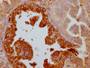 IHC image of CAC12318 diluted at 1:100 and staining in paraffin-embedded human prostate cancer performed on a Leica BondTM system. After dewaxing and hydration, antigen retrieval was mediated by high pressure in a citrate buffer (pH 6.0). Section was blocked with 10% normal goat serum 30min at RT. Then primary antibody (1% BSA) was incubated at 4? overnight. The primary is detected by a Goat anti-rabbit IgG polymer labeled by HRP and visualized using 0.05% DAB.