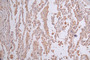 IHC image of CAC12326 diluted at 1:50 and staining in paraffin-embedded human lung cancer performed on a Leica BondTM system. After dewaxing and hydration, antigen retrieval was mediated by high pressure in a citrate buffer (pH 6.0). Section was blocked with 10% normal goat serum 30min at RT. Then primary antibody (1% BSA) was incubated at 4°C overnight. The primary is detected by a Goat anti-rabbit polymer IgG labeled by HRP and visualized using 0.26% DAB.