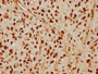 IHC image of CAC12327 diluted at 1:115 and staining in paraffin-embedded human glioma cancer performed on a Leica BondTM system. After dewaxing and hydration, antigen retrieval was mediated by high pressure in a citrate buffer (pH 6.0). Section was blocked with 10% normal goat serum 30min at RT. Then primary antibody (1% BSA) was incubated at 4? overnight. The primary is detected by a biotinylated secondary antibody and visualized using an HRP conjugated SP system.