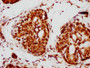 IHC image of CAC12327 diluted at 1:115 and staining in paraffin-embedded human breast cancer performed on a Leica BondTM system. After dewaxing and hydration, antigen retrieval was mediated by high pressure in a citrate buffer (pH 6.0). Section was blocked with 10% normal goat serum 30min at RT. Then primary antibody (1% BSA) was incubated at 4? overnight. The primary is detected by a biotinylated secondary antibody and visualized using an HRP conjugated SP system.