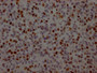 IHC image of CAC12372 diluted at 1:100 and staining in paraffin-embedded human glioma cancer performed on a Leica BondTM system. After dewaxing and hydration, antigen retrieval was mediated by high pressure in a citrate buffer (pH 6.0). Section was blocked with 10% normal goat serum 30min at RT. Then primary antibody (1% BSA) was incubated at 4? overnight. The primary is detected by a Goat anti-rabbit IgG polymer labeled by HRP and visualized using 0.05% DAB.