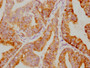 IHC image of CAC12387 diluted at 1:79.75 and staining in paraffin-embedded human endometrial cancer performed on a Leica BondTM system. After dewaxing and hydration, antigen retrieval was mediated by high pressure in a citrate buffer (pH 6.0). Section was blocked with 10% normal goat serum 30min at RT. Then primary antibody (1% BSA) was incubated at 4? overnight. The primary is detected by a biotinylated secondary antibody and visualized using an HRP conjugated SP system.