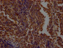 IHC image of CAC12403 diluted at 1:100 and staining in paraffin-embedded human lung cancer performed on a Leica BondTM system. After dewaxing and hydration, antigen retrieval was mediated by high pressure in a citrate buffer (pH 6.0). Section was blocked with 10% normal goat serum 30min at RT. Then primary antibody (1% BSA) was incubated at 4? overnight. The primary is detected by a Goat anti-rabbit IgG polymer labeled by HRP and visualized using 0.05% DAB.