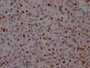 IHC image of CAC12410 diluted at 1:100 and staining in paraffin-embedded human glioma cancer performed on a Leica BondTM system. After dewaxing and hydration, antigen retrieval was mediated by high pressure in a citrate buffer (pH 6.0). Section was blocked with 10% normal goat serum 30min at RT. Then primary antibody (1% BSA) was incubated at 4? overnight. The primary is detected by a Goat anti-rabbit IgG polymer labeled by HRP and visualized using 0.05% DAB.