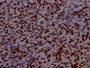 IHC image of CAC12414 diluted at 1:100 and staining in paraffin-embedded human bladder cancer performed on a Leica BondTM system. After dewaxing and hydration, antigen retrieval was mediated by high pressure in a citrate buffer (pH 6.0). Section was blocked with 10% normal goat serum 30min at RT. Then primary antibody (1% BSA) was incubated at 4? overnight. The primary is detected by a Goat anti-rabbit IgG polymer labeled by HRP and visualized using 0.05% DAB.