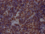 IHC image of CAC12421 diluted at 1:100 and staining in paraffin-embedded human lung cancer performed on a Leica BondTM system. After dewaxing and hydration, antigen retrieval was mediated by high pressure in a citrate buffer (pH 6.0). Section was blocked with 10% normal goat serum 30min at RT. Then primary antibody (1% BSA) was incubated at 4? overnight. The primary is detected by a Goat anti-rabbit IgG polymer labeled by HRP and visualized using 0.05% DAB.
