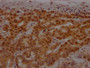 IHC image of CAC12422 diluted at 1:100 and staining in paraffin-embedded human breast cancer performed on a Leica BondTM system. After dewaxing and hydration, antigen retrieval was mediated by high pressure in a citrate buffer (pH 6.0). Section was blocked with 10% normal goat serum 30min at RT. Then primary antibody (1% BSA) was incubated at 4? overnight. The primary is detected by a Goat anti-rabbit IgG polymer labeled by HRP and visualized using 0.05% DAB.