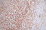 IHC image of CAC12423 diluted at 1:100 and staining in paraffin-embedded human glioma cancer performed on a Leica BondTM system. After dewaxing and hydration, antigen retrieval was mediated by high pressure in a citrate buffer (pH 6.0). Section was blocked with 10% normal goat serum 30min at RT. Then primary antibody (1% BSA) was incubated at 4°C overnight. The primary is detected by a Goat anti-rabbit polymer IgG labeled by HRP and visualized using 0.55% DAB.