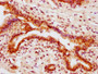 IHC image of CAC12435 diluted at 1:100 and staining in paraffin-embedded human breast cancer performed on a Leica BondTM system. After dewaxing and hydration, antigen retrieval was mediated by high pressure in a citrate buffer (pH 6.0). Section was blocked with 10% normal goat serum 30min at RT. Then primary antibody (1% BSA) was incubated at 4? overnight. The primary is detected by a biotinylated secondary antibody and visualized using an HRP conjugated SP system.