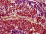 IHC image of CAC12435 diluted at 1:100 and staining in paraffin-embedded human lung cancer performed on a Leica BondTM system. After dewaxing and hydration, antigen retrieval was mediated by high pressure in a citrate buffer (pH 6.0). Section was blocked with 10% normal goat serum 30min at RT. Then primary antibody (1% BSA) was incubated at 4? overnight. The primary is detected by a biotinylated secondary antibody and visualized using an HRP conjugated SP system.