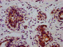 IHC image of CAC12445 diluted at 1:100 and staining in paraffin-embedded human breast cancer performed on a Leica BondTM system. After dewaxing and hydration, antigen retrieval was mediated by high pressure in a citrate buffer (pH 6.0). Section was blocked with 10% normal goat serum 30min at RT. Then primary antibody (1% BSA) was incubated at 4? overnight. The primary is detected by a biotinylated secondary antibody and visualized using an HRP conjugated SP system.